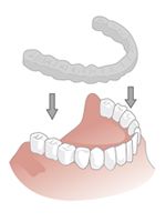 Illustration einer Knirscherschiene